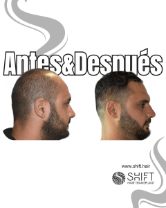 Antes y después de un trasplante capilar para la calvicie de Norwood 5 en Turquía en SHIFT Hair en Estambul 15 3