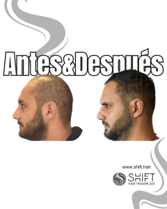 Antes y después de un trasplante capilar para la calvicie de Norwood 5 en Turquía en SHIFT Hair en Estambul 16 3