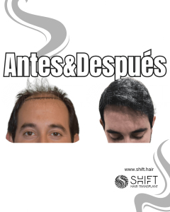 Antes y después de un trasplante capilar para la calvicie de Norwood 6 en Turquía en SHIFT Hair en Estambul 04 3