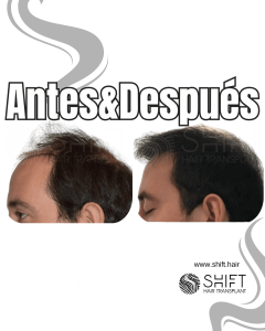 Antes y después de un trasplante capilar para la calvicie de Norwood 6 en Turquía en SHIFT Hair en Estambul 05 3