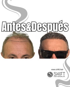 Antes y después de un trasplante capilar para la calvicie de Norwood 6 en Turquía en SHIFT Hair en Estambul 09 3