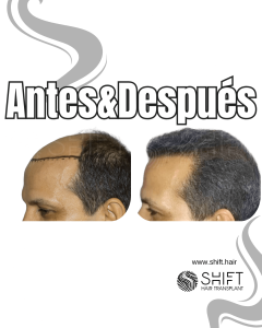 Antes y después de un trasplante capilar para la calvicie de Norwood 6 en Turquía en SHIFT Hair en Estambul 11 3