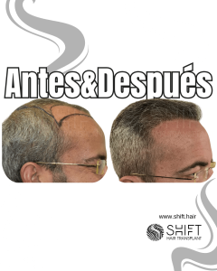 Antes y después de un trasplante capilar para la calvicie de Norwood 6 en Turquía en SHIFT Hair en Estambul 12 3