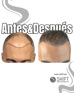 Antes y después de un trasplante capilar para la calvicie de Norwood 6 en Turquía en SHIFT Hair en Estambul 15 3