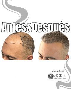 Antes y después de un trasplante capilar para la calvicie de Norwood 6 en Turquía en SHIFT Hair en Estambul 16 3