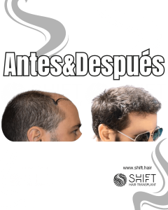 Antes y después de un trasplante capilar para la calvicie de Norwood 6 en Turquía en SHIFT Hair en Estambul 18 3