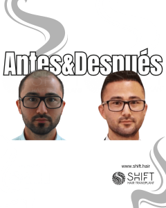 Antes y después de un trasplante capilar para la calvicie de Norwood 7 en Turquía en SHIFT Hair en Estambul 01 3