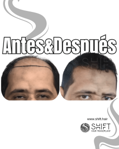 Antes y después de un trasplante capilar para la calvicie de Norwood 7 en Turquía en SHIFT Hair en Estambul 02 3