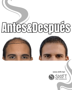 Antes y después de un trasplante capilar para la calvicie de Norwood 7 en Turquía en SHIFT Hair en Estambul 03 3