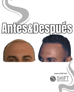 Antes y después de un trasplante capilar para la calvicie de Norwood 7 en Turquía en SHIFT Hair en Estambul 04 3