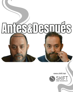 Antes y después de un trasplante capilar para la calvicie de Norwood 7 en Turquía en SHIFT Hair en Estambul 09 3