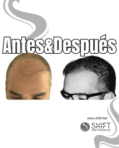Antes y después de un trasplante capilar para la calvicie de Norwood 7 en Turquía en SHIFT Hair en Estambul 10 3