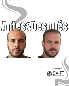 Antes y después de un trasplante capilar para la calvicie de Norwood 7 en Turquía en SHIFT Hair en Estambul 13 3