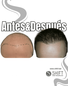 Antes y después de un trasplante capilar para la calvicie de Norwood 7 en Turquía en SHIFT Hair en Estambul 17 3