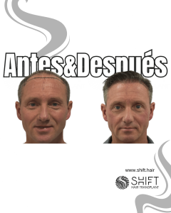 Antes y después de un trasplante capilar para la calvicie de Norwood 7 en Turquía en SHIFT Hair en Estambul 18 3