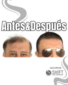Antes y después de un trasplante capilar para la calvicie de Norwood 7 en Turquía en SHIFT Hair en Estambul 19 3