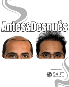 Antes y después de un trasplante capilar para la calvicie de Norwood 7 en Turquía en SHIFT Hair en Estambul 20 3