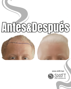 Antes y después de un trasplante de cabello albino para la calvicie Norwood 4 en Turquía en SHIFT Hair en Estambul 01 3