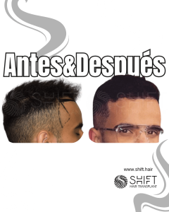 Antes y después de un trasplante de cabello en la sien en Turquía en SHIFT Hair en Estambul 01 3