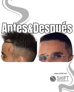 Antes y después de un trasplante de cabello en la sien en Turquía en SHIFT Hair en Estambul 02 3