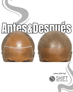 Antes y después de una micropigmentación capilar afro para un look afeitado en Turquía en SHIFT Hair en Estambul 02 3