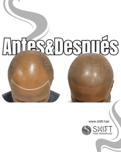 Antes y después de una micropigmentación capilar afro para un look afeitado en Turquía en SHIFT Hair en Estambul 03 3