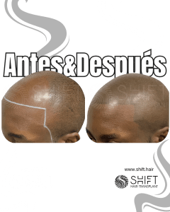 Antes y después de una micropigmentación capilar afro para un look afeitado en Turquía en SHIFT Hair en Estambul 05 3