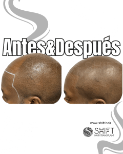 Antes y después de una micropigmentación capilar afro para un look afeitado en Turquía en SHIFT Hair en Estambul 07 3