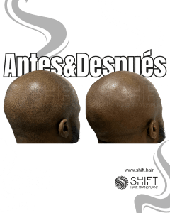 Antes y después de una micropigmentación capilar afro para un look afeitado en Turquía en SHIFT Hair en Estambul 08 3
