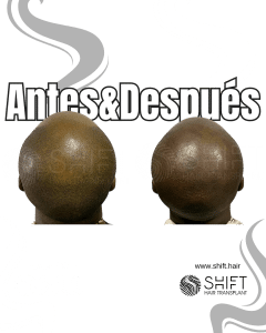 Antes y después de una micropigmentación capilar afro para un look afeitado en Turquía en SHIFT Hair en Estambul 10 3