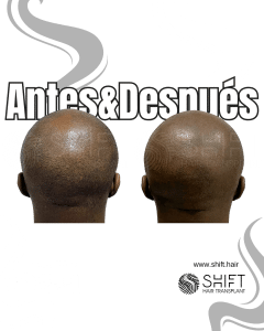 Antes y después de una micropigmentación capilar afro para un look afeitado en Turquía en SHIFT Hair en Estambul 11 3