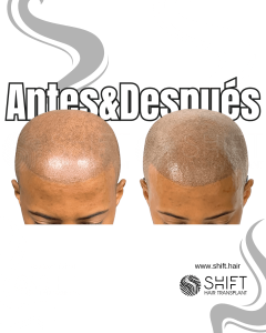Antes y después de una micropigmentación capilar afro para un look afeitado en Turquía en SHIFT Hair en Estambul 13 3