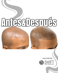 Antes y después de una micropigmentación capilar afro para un look afeitado en Turquía en SHIFT Hair en Estambul 15 3