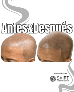 Antes y después de una micropigmentación capilar afro para un look afeitado en Turquía en SHIFT Hair en Estambul 16 3