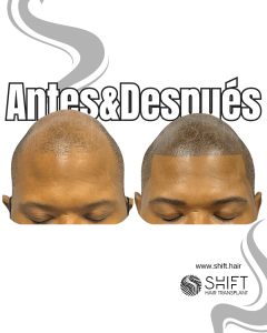 Antes y después de una micropigmentación capilar afro para un look afeitado en Turquía en SHIFT Hair en Estambul 19 3