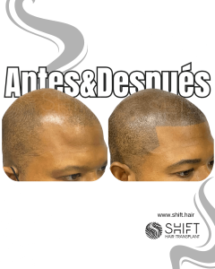 Antes y después de una micropigmentación capilar afro para un look afeitado en Turquía en SHIFT Hair en Estambul 20 3