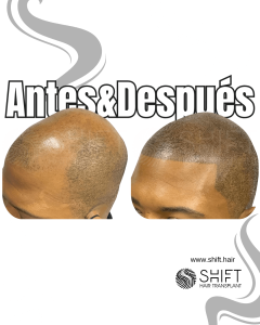 Antes y después de una micropigmentación capilar afro para un look afeitado en Turquía en SHIFT Hair en Estambul 21 3
