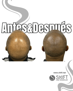 Antes y después de una micropigmentación capilar afro para un look afeitado en Turquía en SHIFT Hair en Estambul 22 3