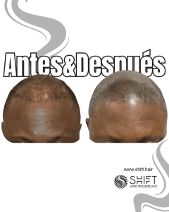 Antes y después de una micropigmentación capilar afro para un look afeitado en Turquía en SHIFT Hair en Estambul 24 3
