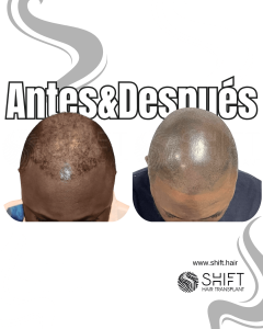 Antes y después de una micropigmentación capilar afro para un look afeitado en Turquía en SHIFT Hair en Estambul 25 3