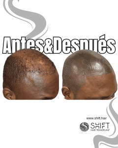 Antes y después de una micropigmentación capilar afro para un look afeitado en Turquía en SHIFT Hair en Estambul 26 3
