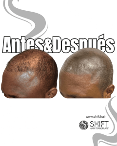 Antes y después de una micropigmentación capilar afro para un look afeitado en Turquía en SHIFT Hair en Estambul 27 3