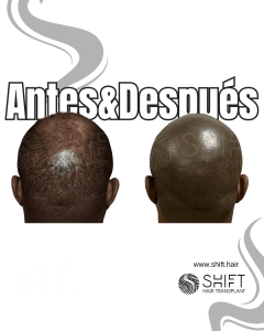 Antes y después de una micropigmentación capilar afro para un look afeitado en Turquía en SHIFT Hair en Estambul 28 3