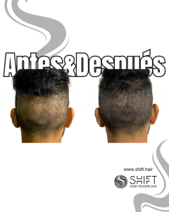 Antes y después de una micropigmentación capilar para corregir la zona donante en Turquía en SHIFT Hair en Estambul 04 3