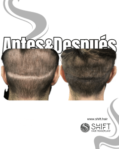 Antes y después de una micropigmentación capilar para corregir la zona donante en Turquía en SHIFT Hair en Estambul 05 3