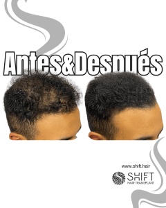 Antes y después de una micropigmentación capilar para un camuflaje de densidad en Turquía en SHIFT Hair en Estambul 02 3