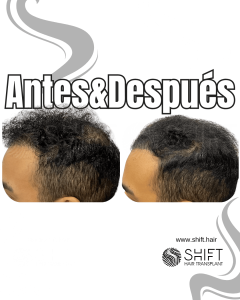 Antes y después de una micropigmentación capilar para un camuflaje de densidad en Turquía en SHIFT Hair en Estambul 04 3
