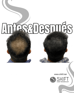 Antes y después de una micropigmentación capilar para un camuflaje de densidad en Turquía en SHIFT Hair en Estambul 05 3