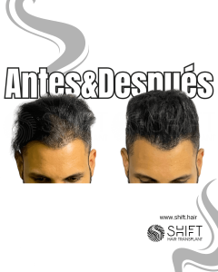 Antes y después de una micropigmentación capilar para un camuflaje de densidad en Turquía en SHIFT Hair en Estambul 08 3