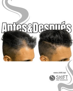 Antes y después de una micropigmentación capilar para un camuflaje de densidad en Turquía en SHIFT Hair en Estambul 10 3